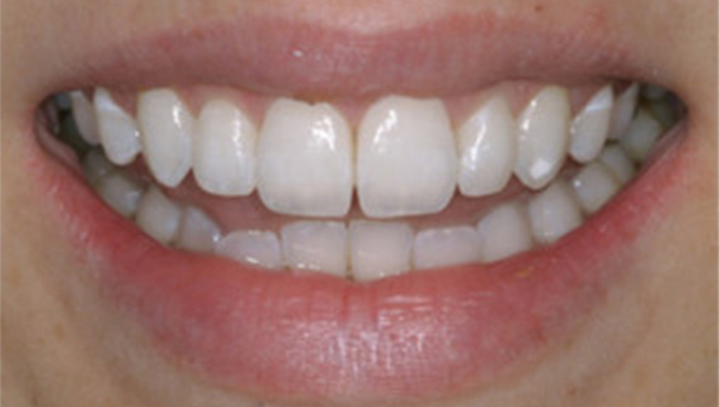 Aligners After