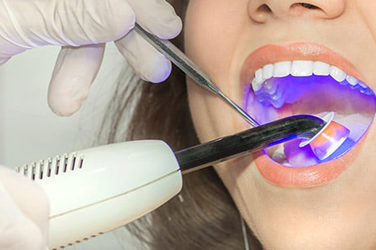 Laser Fillings