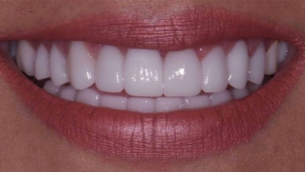 Hollywood Smile Makeover After