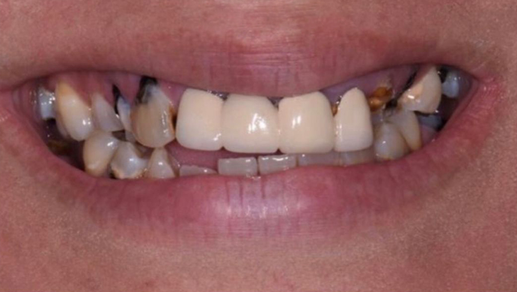 Hollywood Smile Makeover Before