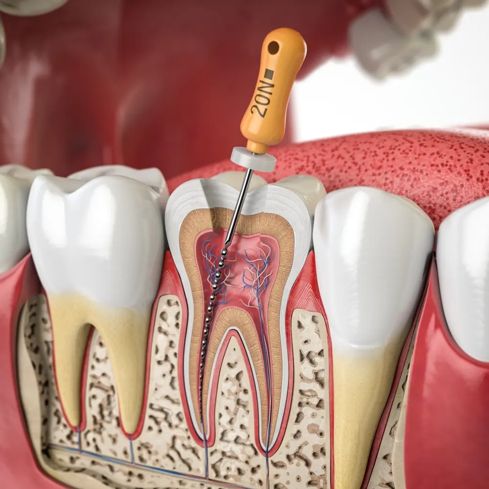 What is Rotary Endodontics